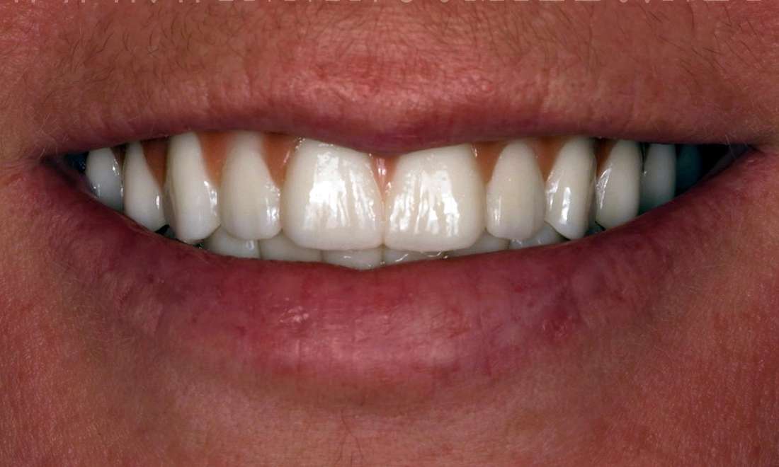 After full mouth rehabilitation with 12 implants, fontana ca