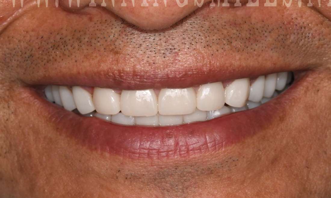 Close up of teeth after full mouth rehabilitation with veneers and crowns, fontana ca
