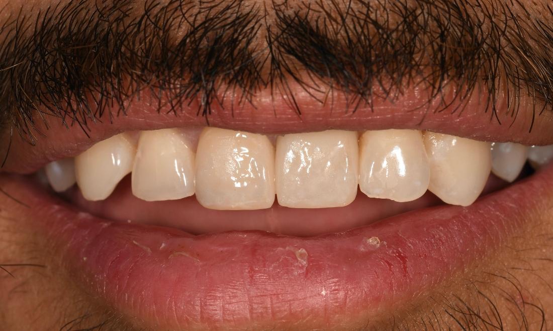 After Cosmetic Fillings, Crown and Implant in Winning Smiles Fontana CA