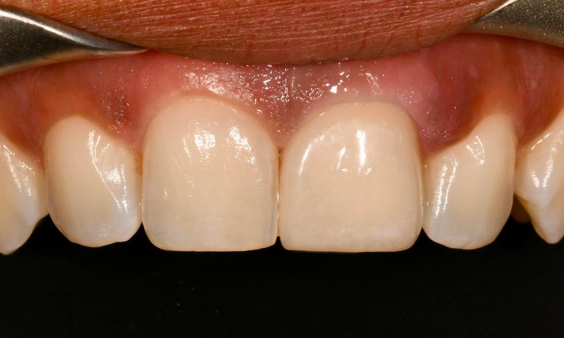 After Porcelain Veneer in Winning Smiles