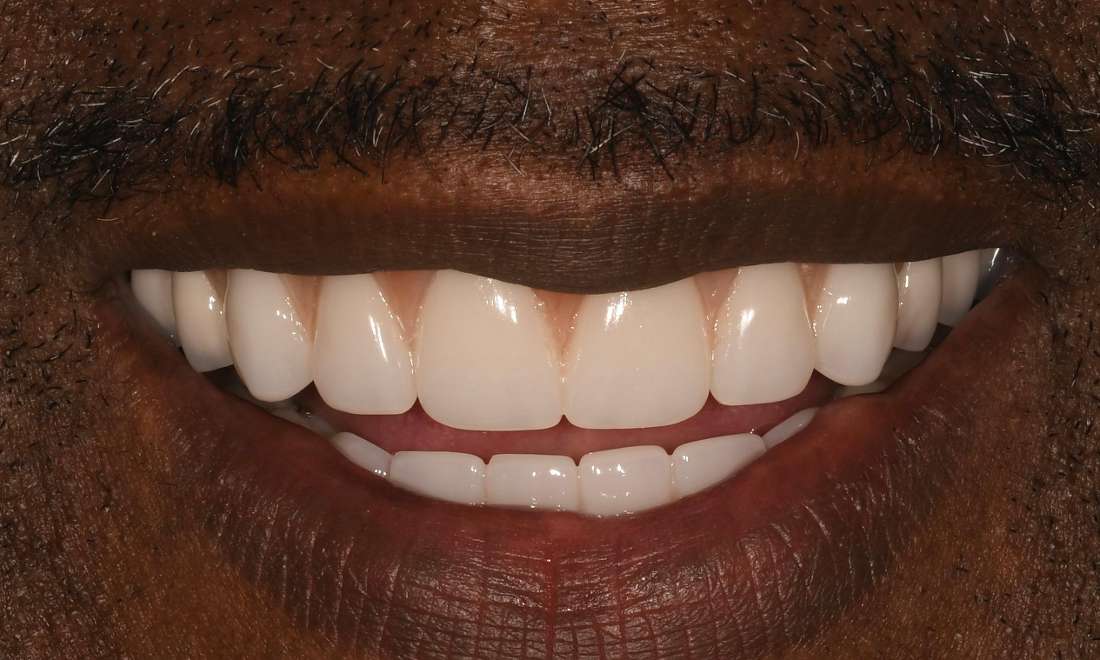 Close up of mouth after dentures and implants, fontana ca