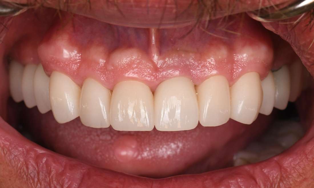 Close up of mouth after smile transformation, fontana ca