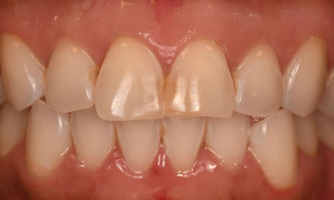 Close up of a smile before veneers, fontana ca
