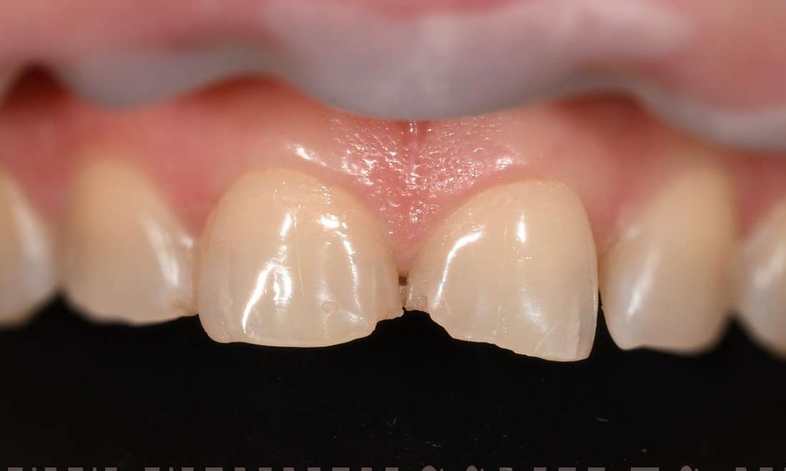 Before veneers on chipped teeth, fontana ca