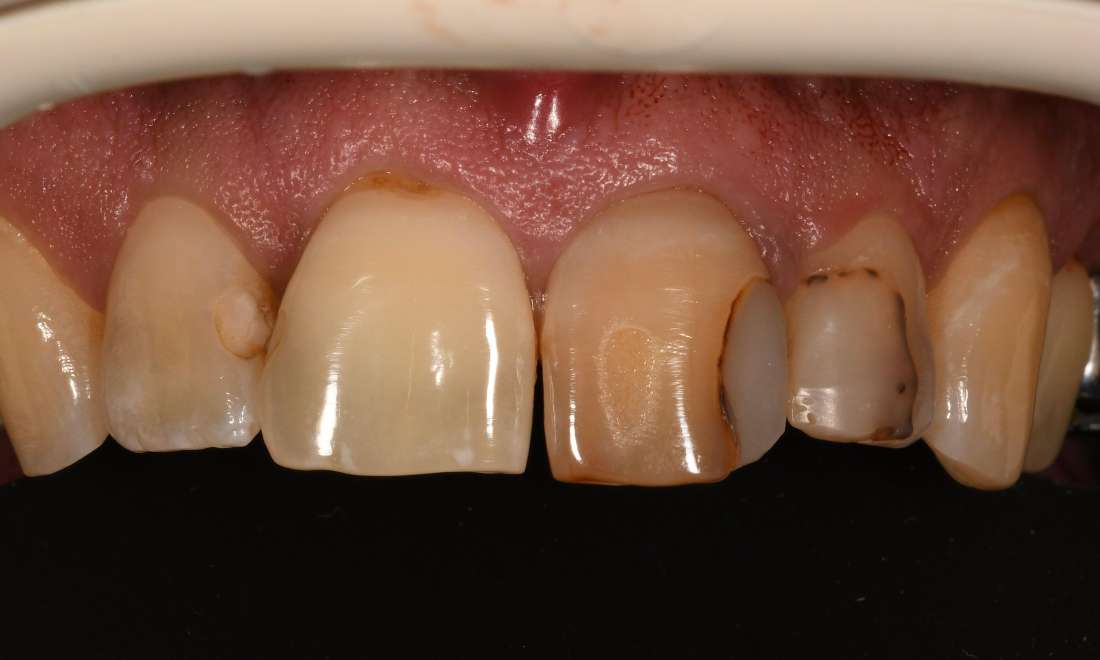 Close up of mouth before cosmetic crown and fillings, fontana ca
