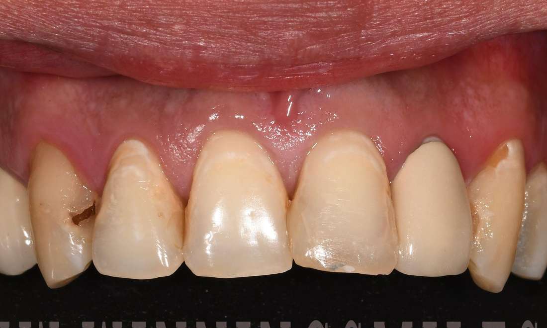 Close up of teeth before crowns and veeners, fontana ca
