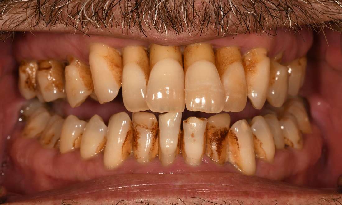 Mouth before full mouth rehabilitation, fontana ca