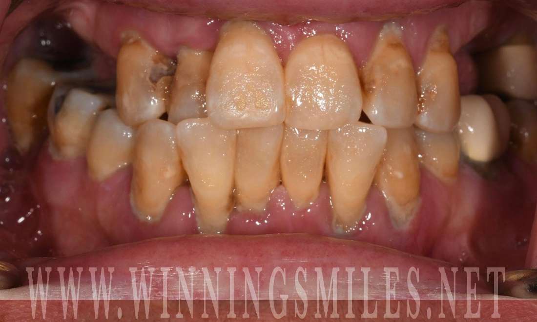 Before full mouth rehabilitation with 12 implants, fontana ca