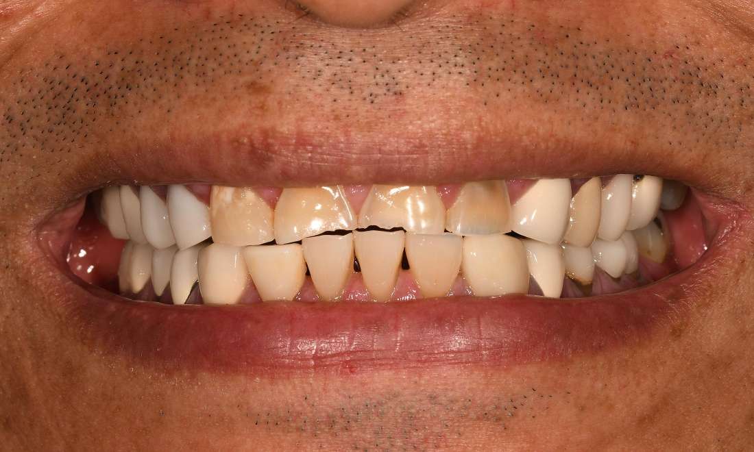 Close up of teeth before full mouth rehabilitation with veneers and crowns, fontana ca