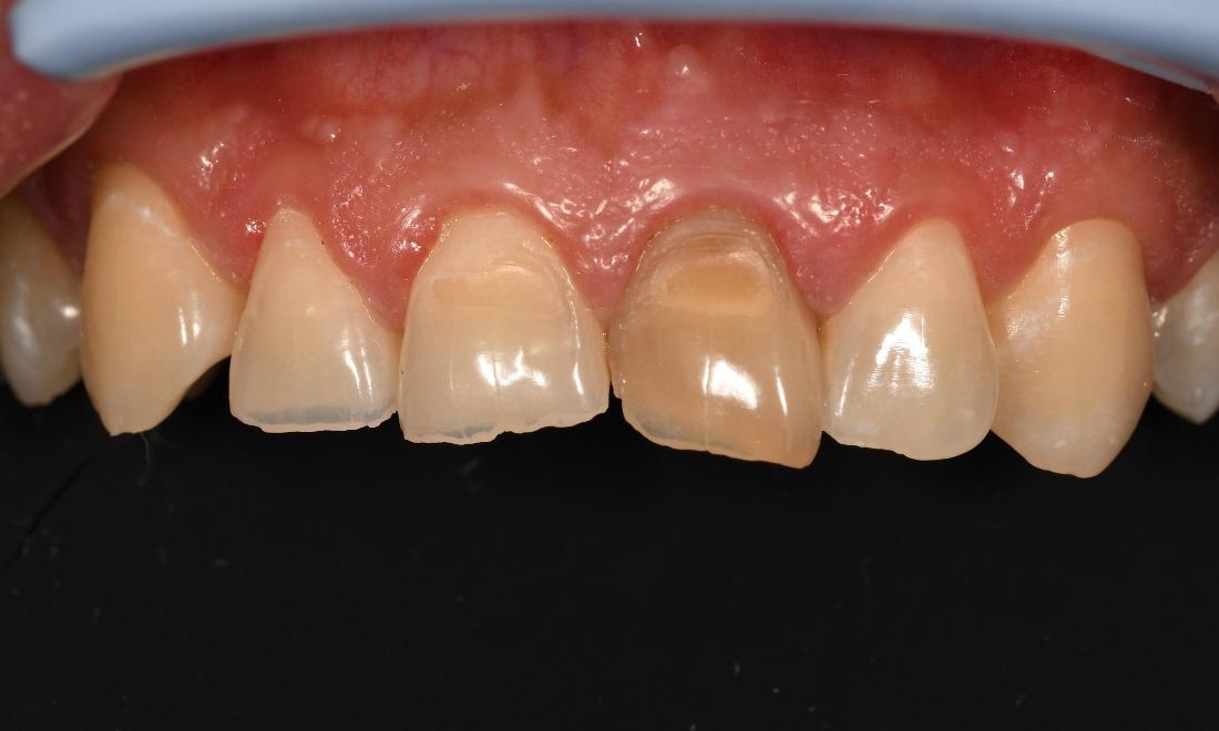 Before Cosmetic Fillings, Crown and Implant in Winning Smiles Fontana CA