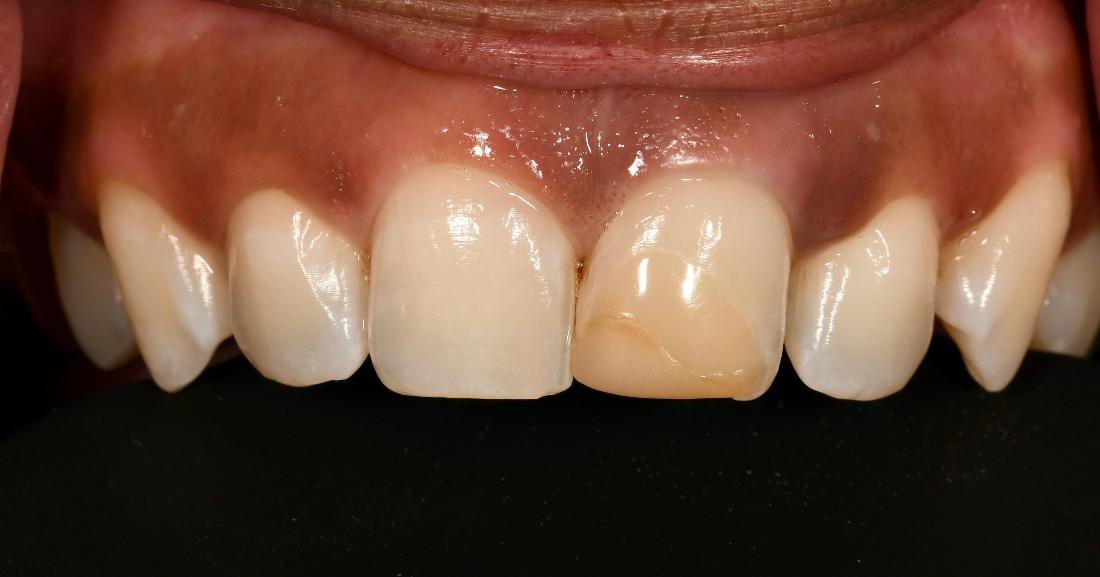 Before Porcelain Veneer in Winning Smiles
