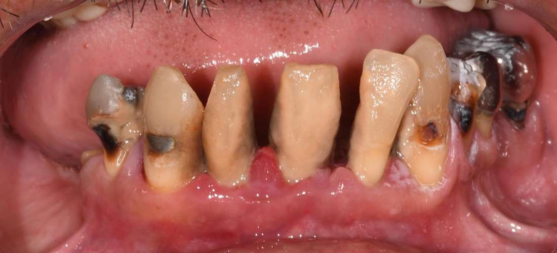 Before rehabilitation of the lower arch with 3 implants and an premium overdenture