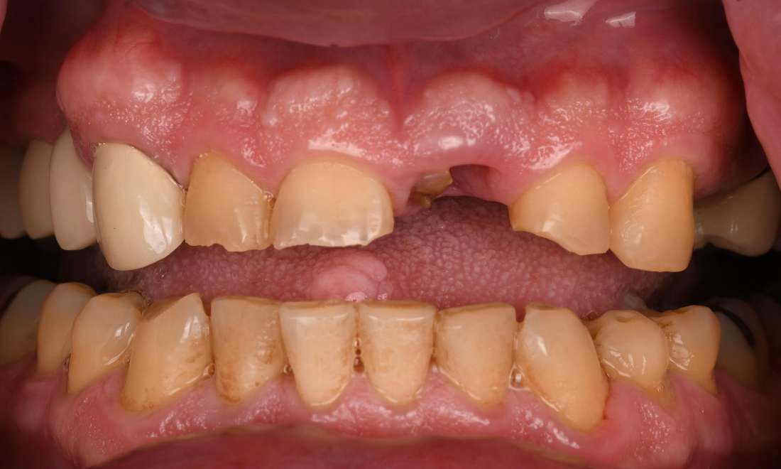 Close up of mouth before smile transformation, fontana ca