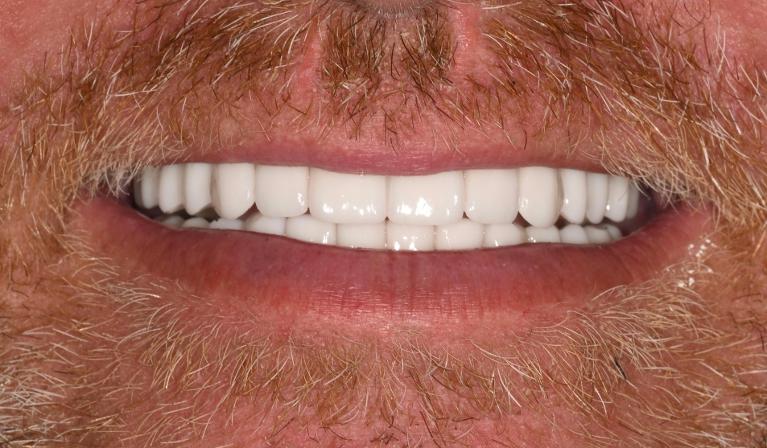 After Porcelain layered Zirconia Bridge in Winning Smiles Fontana CA