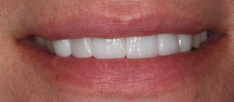 Cosmetic Dental Crowns in Fontana | Before