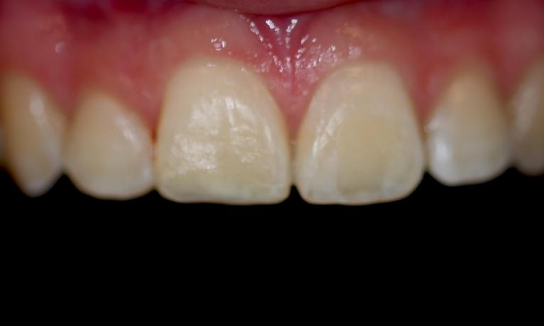 Cosmetic-Filling-After-Image