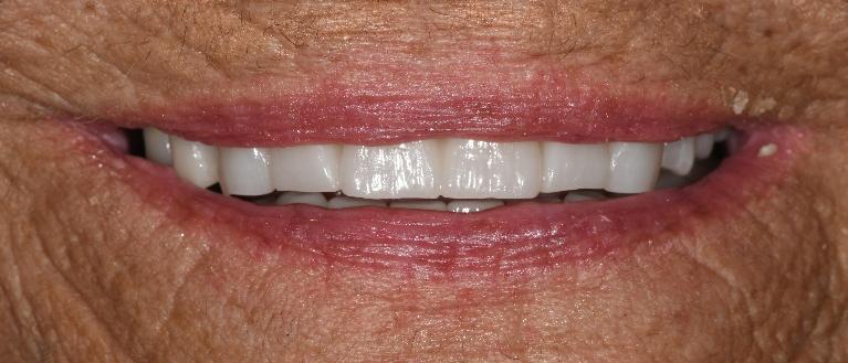 Smile Makeover in Fontana | After