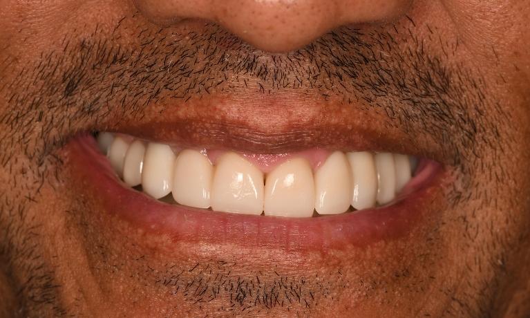 Full-Mouth-Rehabilitation-After-Image