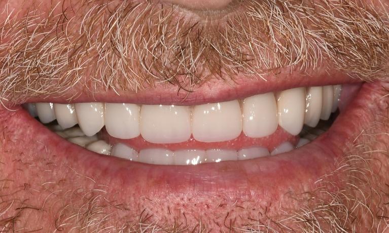 Tooth Replacement in Fontana | After