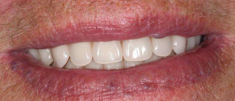 Dental Implants in Fontana | After