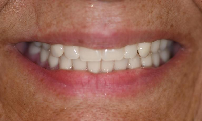 Dentures in Fontana | AFter