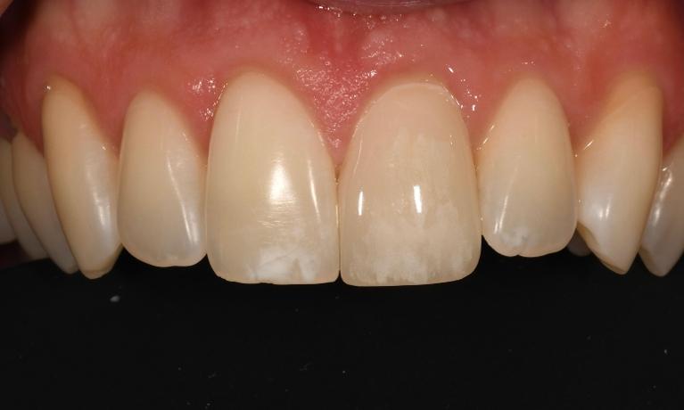 Same-Day-Veneer-Replacement-After-Image