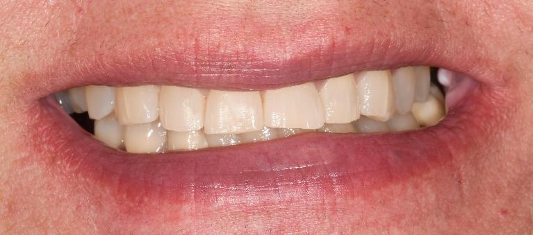 Six-Month-Smiles-After-Image