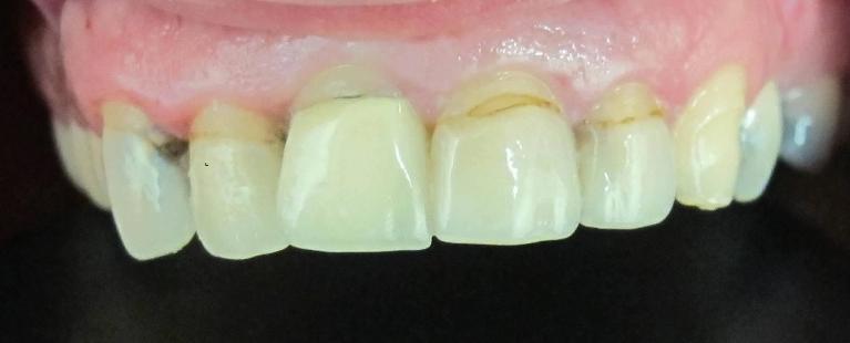 Cosmetic Crowns in Fontana | Before