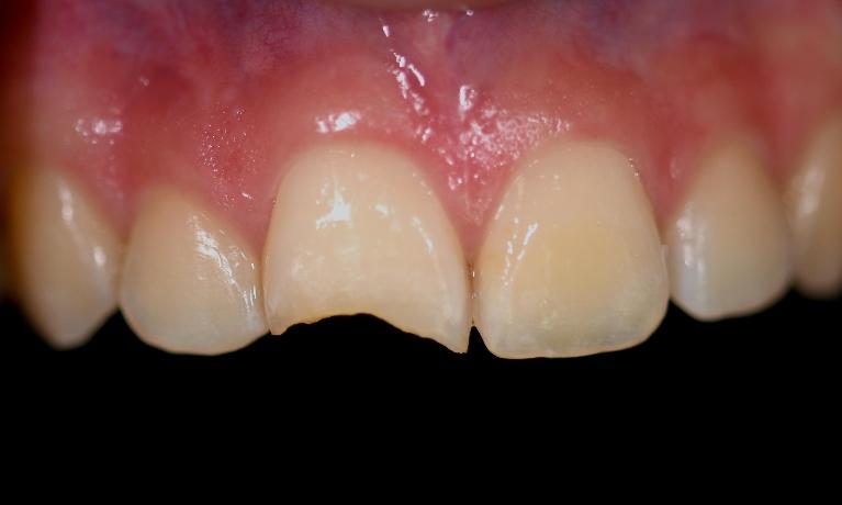 Cosmetic-Filling-Before-Image