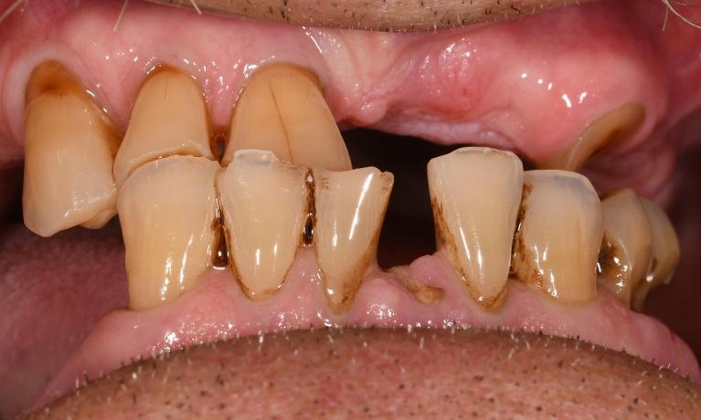 Full Mouth Rehab in Fontana | Before