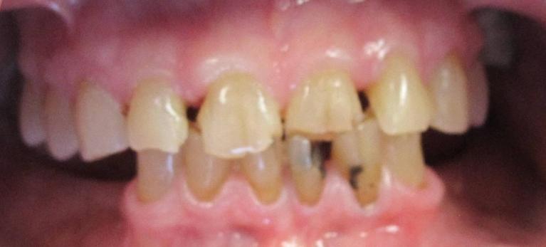 Smile Makeover in Fontana | Before