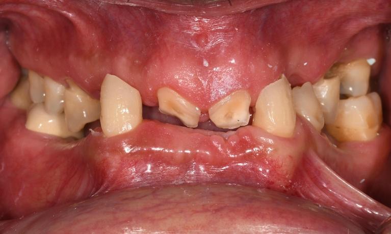 Full-Mouth-Rehabilitation-Before-Image