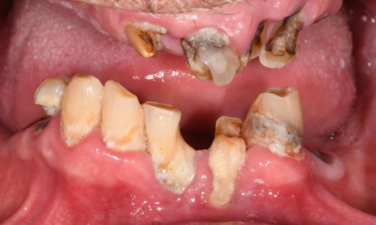 Tooth Replacement in Fontana | Before