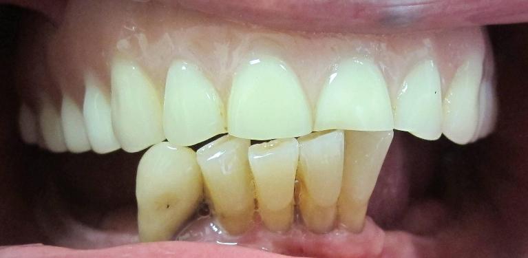 Dental Implants in Fontana | Before