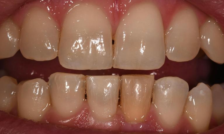 Internal-Bleaching-after-a-Root-Canal-Treatment-Before-Image