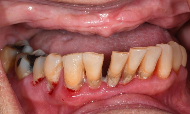 Dentures in Fontana | Before