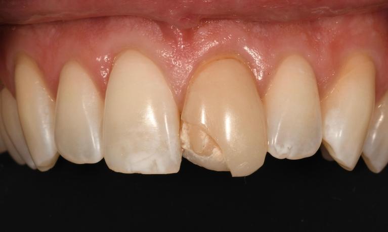 Same-Day-Veneer-Replacement-Before-Image