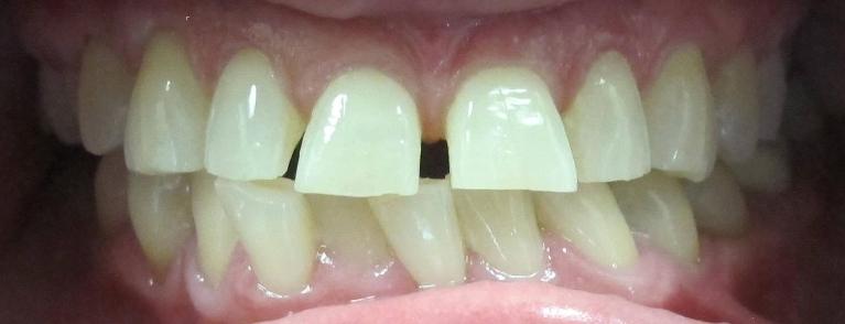 Six-Month-Smiles-Before-Image
