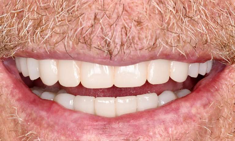 All-on-X-with-Crowns-After-Image