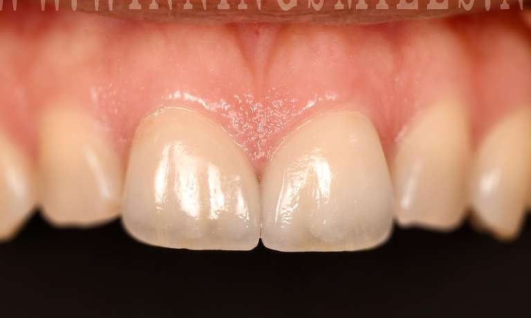 After veneers on chipped teeth, fontana ca