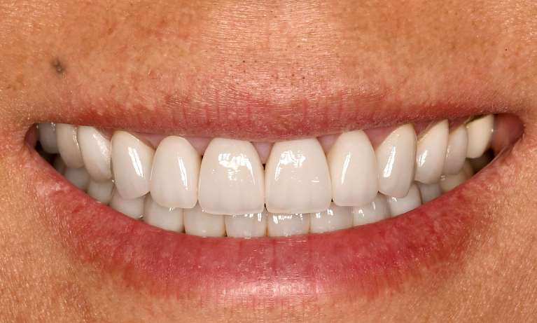 Cosmetic-Crowns-After-Image