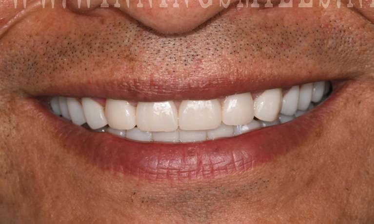 Close up of teeth after full mouth rehabilitation with veneers and crowns, fontana ca