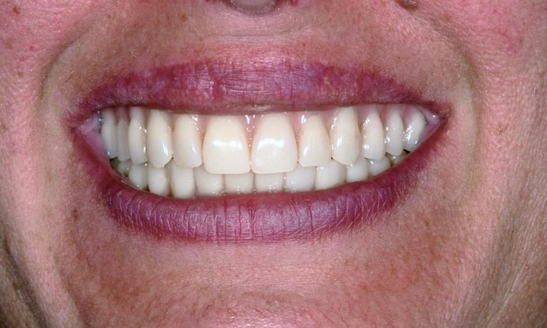 Dental-Implant-Tooth-Replacement-After-Image