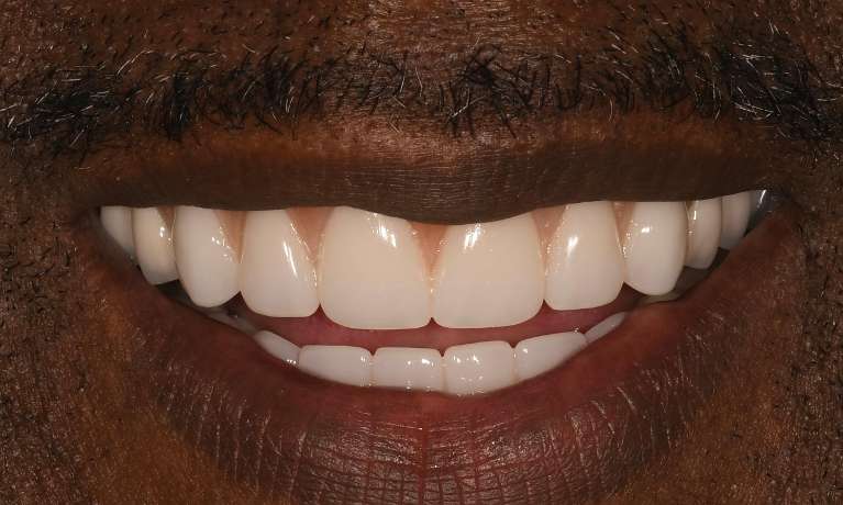 Quality-Dentures-with-some-implants-After-Image