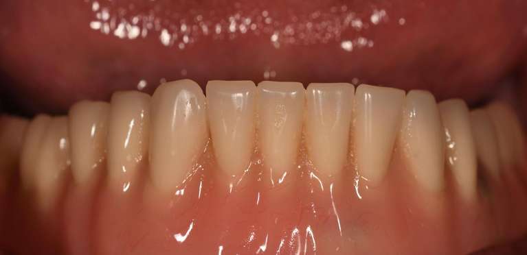 Rehabilitation-of-the-lower-arch-with-3-implants-and-an-premium-overdenture-After-Image