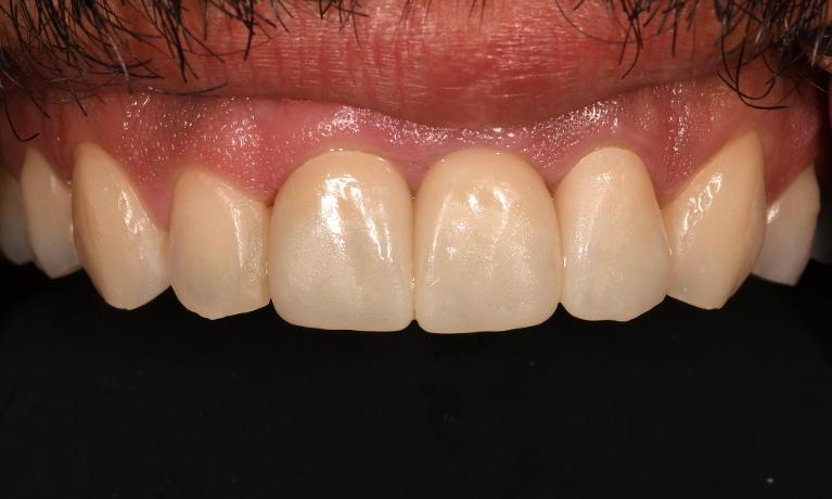 After Dental Implant in Winning Smiles Fontana CA