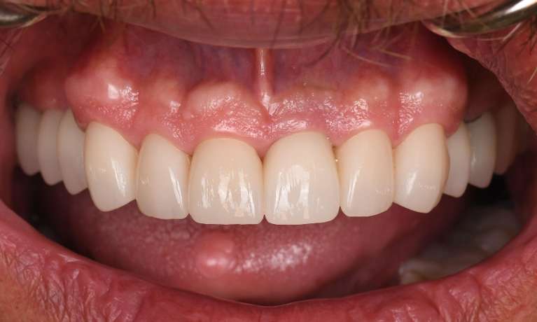 Close up of mouth after smile transformation, fontana ca