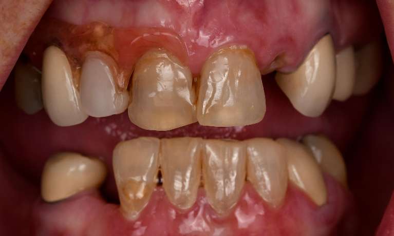 All-on-6-Before-Image