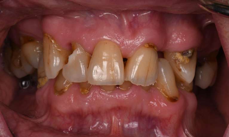 All-on-X-with-Crowns-Before-Image