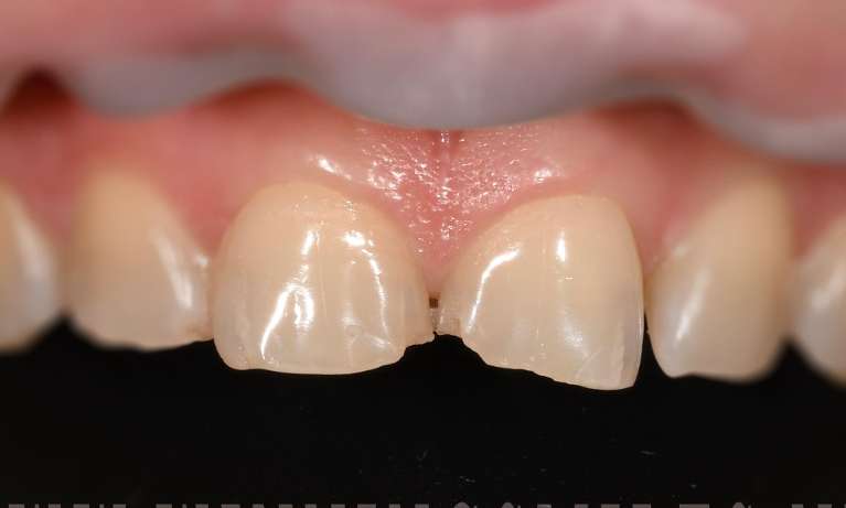 Before veneers on chipped teeth, fontana ca